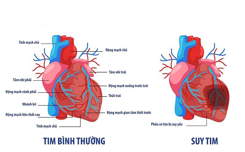 Lịm tim là gì? Gallery 2