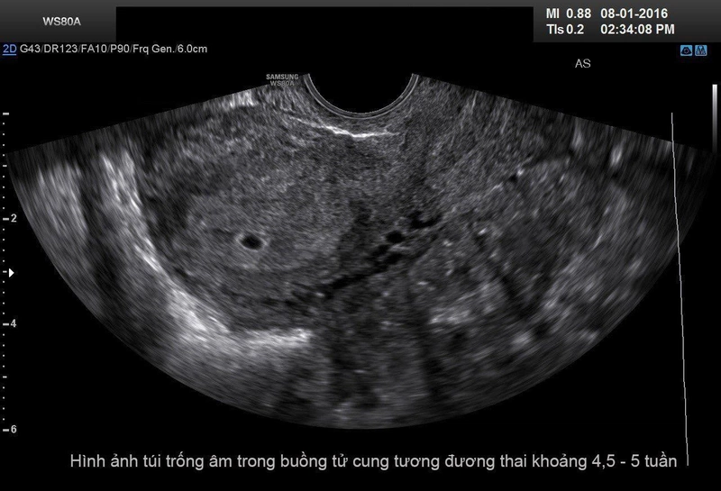 Lòng Tử Cung Trống Là Gì? Gallery 2