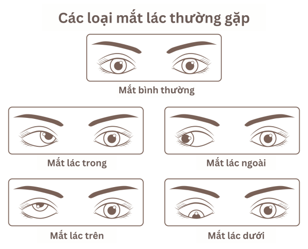 Mắt bị lác nhẹ: Nguyên nhân, triệu chứng và cách điều trị Gallery 2