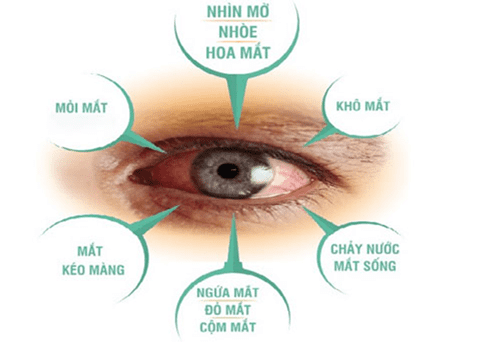 Mắt cận thị là mắt gì? Gallery 2