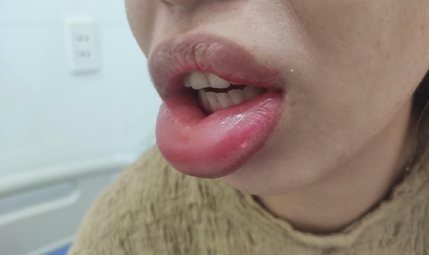 Môi dưới bị trề: Nguyên nhân, triệu chứng và cách khắc phục Gallery 2