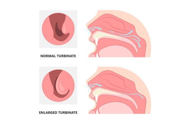 Mũi bị trầy bên trong: Nguyên nhân, triệu chứng và cách điều trị Gallery 2