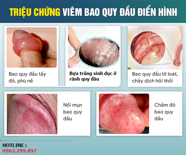 Cậu nhỏ bị nổi mụn: Nguyên nhân, triệu chứng và cách điều trị Gallery 2