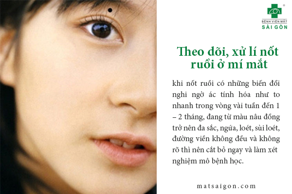 Mụn Ruồi Ở Mắt: Nguyên Nhân, Triệu Chứng Và Cách Xử Lý Gallery 2