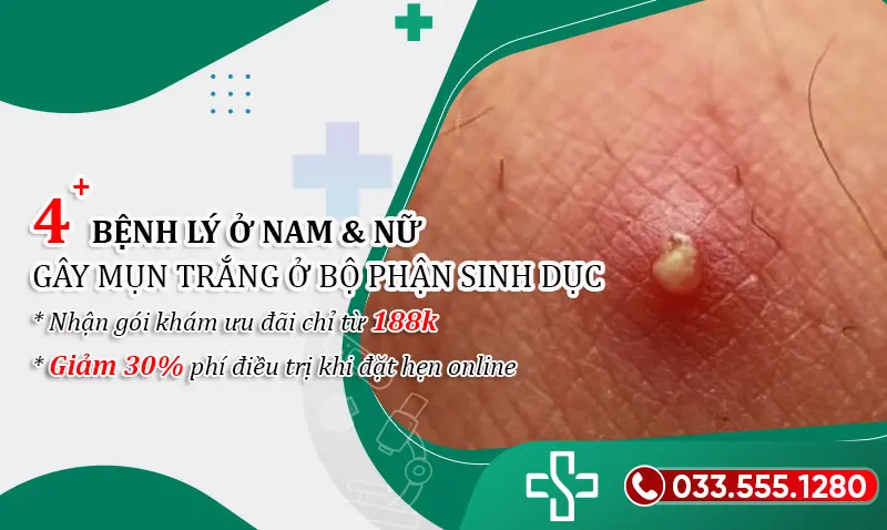 Mụn Trắng Ở Bộ Phận Sinh Dục Nam: Nguyên Nhân, Triệu Chứng Và Cách Điều Trị Gallery 2