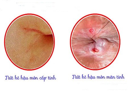 Nứt Hậu Môn Là Gì? Gallery 2