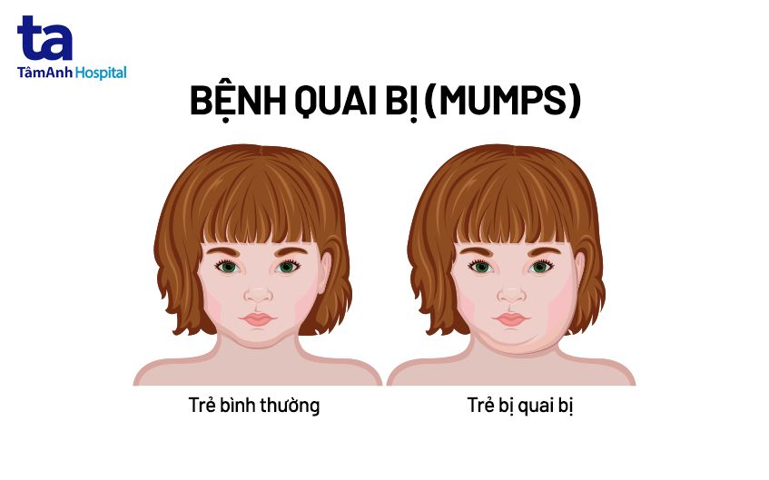 Quai bị ở trẻ em: Nguyên nhân, triệu chứng và cách điều trị Gallery 2