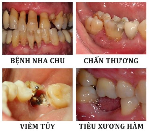 Răng Hàm Bị Lung Lay: Nguyên Nhân, Triệu Chứng Và Cách Khắc Phục Gallery 2