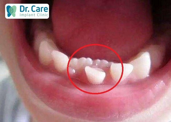Răng Mọc Lẫy Hàm Dưới: Nguyên Nhân, Triệu Chứng Và Cách Khắc Phục Gallery 2