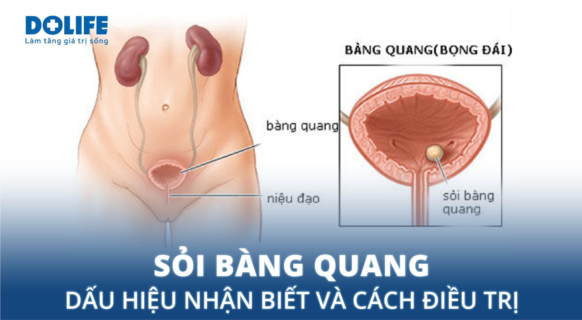Sỏi Bàng Quang Là Gì? Gallery 2