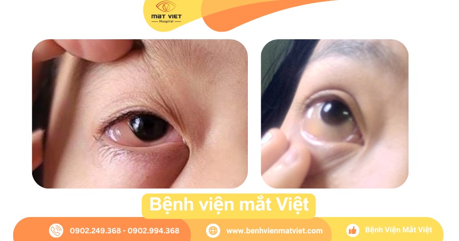 Sưng Tròng Trắng Mắt: Nguyên Nhân, Triệu Chứng và Cách Điều Trị Gallery 2