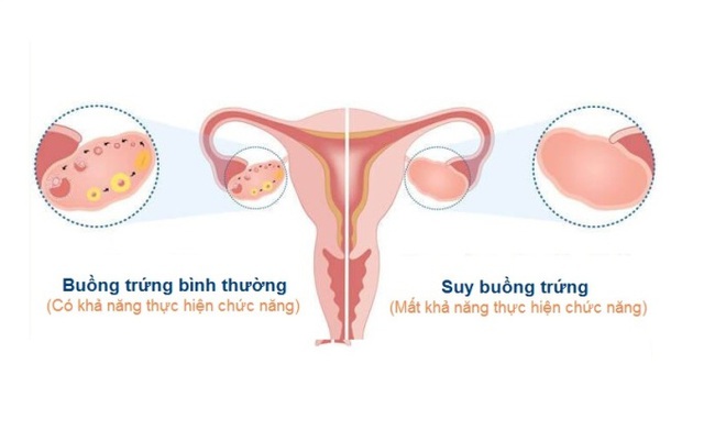 Suy Buồng Trứng Sớm Là Gì? Gallery 2