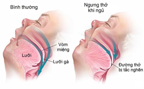 Tắc thở hay tắt thở? Gallery 2