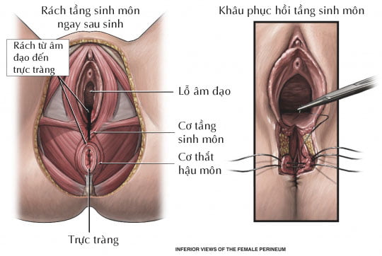 Tầng Sinh Môn Bị Rách: Nguyên Nhân, Triệu Chứng, Điều Trị Và Phòng Ngừa Gallery 2