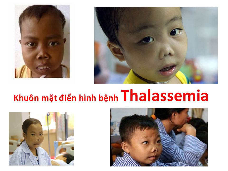 Thiếu Máu Huyết Tán Ở Trẻ Em Gallery 2