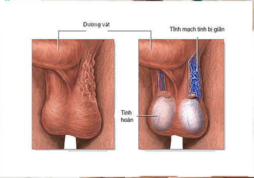 Tinh hoàn bị xệ: Nguyên nhân, triệu chứng và cách điều trị Gallery 2