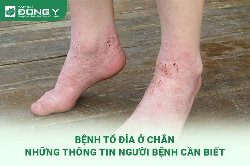 Chân bị tổ đỉa: Nguyên nhân, triệu chứng và cách điều trị Gallery 2