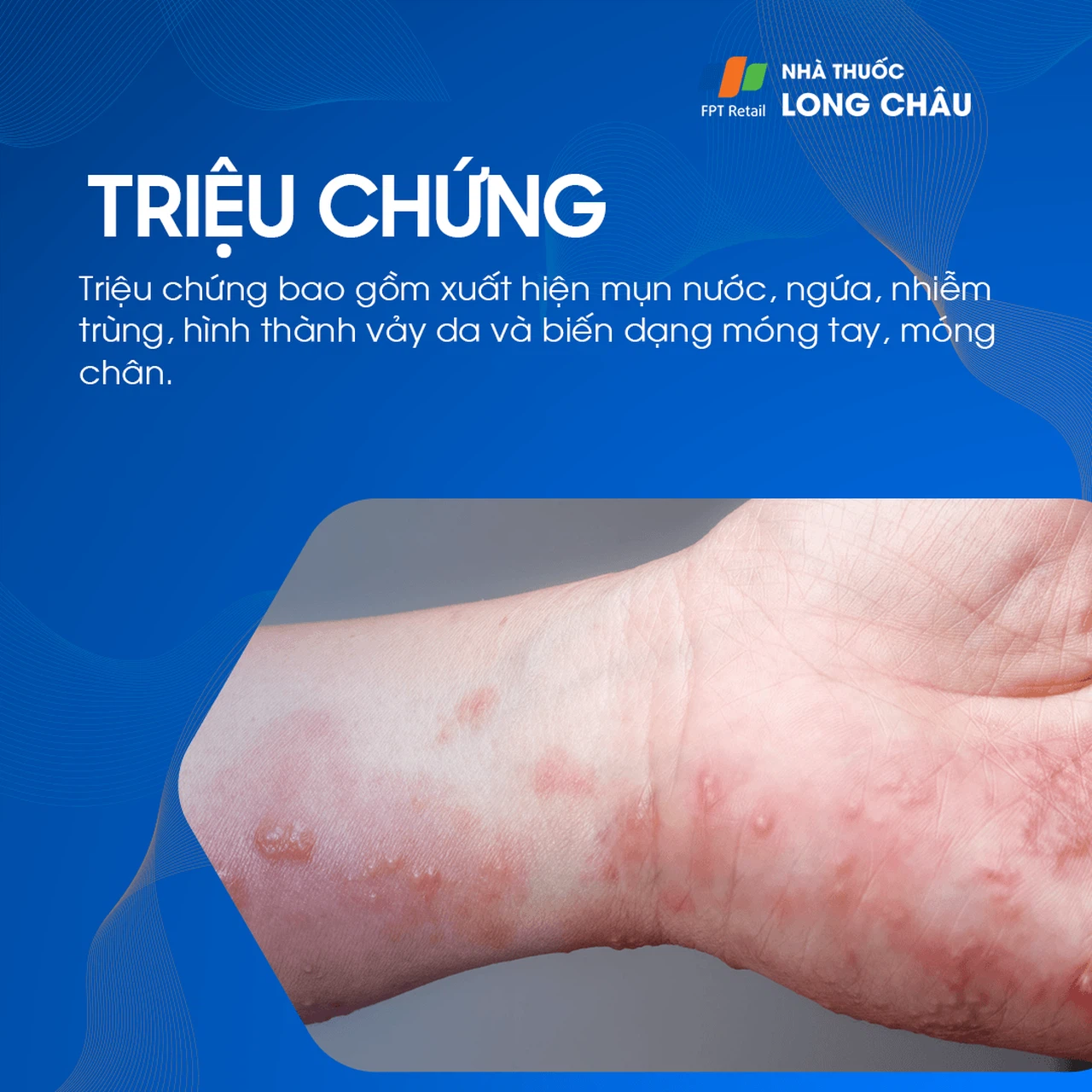 Tổ Đỉa Trên Da: Nguyên Nhân, Triệu Chứng Và Cách Điều Trị Gallery 2