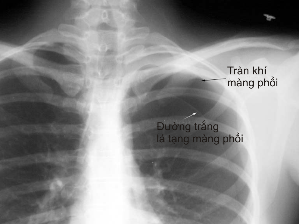 Tràn khí màng phổi có nguy hiểm không? Gallery 2