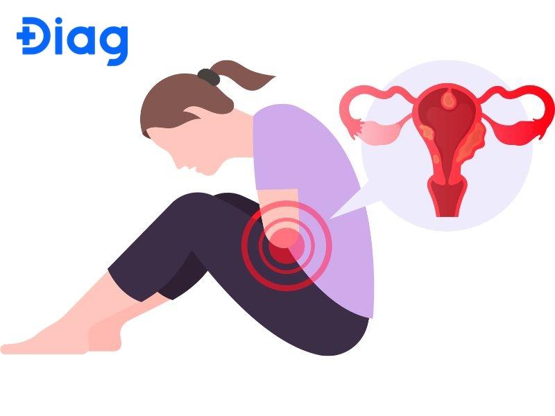 Treo Buồng Trứng Là Gì? Gallery 2