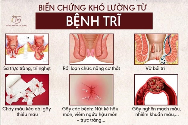 Trĩ Nội Như Thế Nào? Gallery 1
