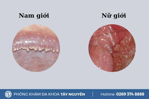 U Nhú Gai Sinh Dục Là Gì? Gallery 1