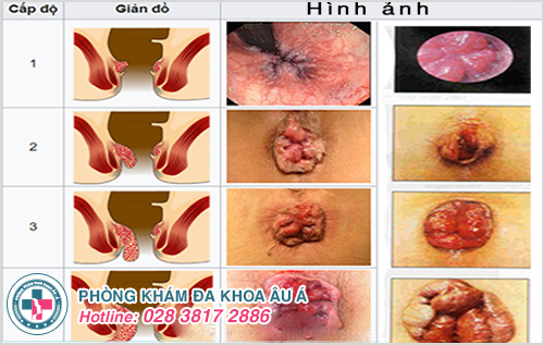U nhú hậu môn Gallery 2