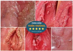 U Nhú Sinh Dục Lành Tính Gallery 2