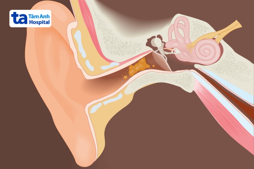 Tai tự nhiên bị ù: Nguyên nhân, triệu chứng và cách khắc phục Gallery 2