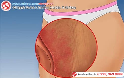 Bị Xước Bên Ngoài Vùng Kín: Nguyên Nhân, Triệu Chứng và Cách Điều Trị Gallery 2