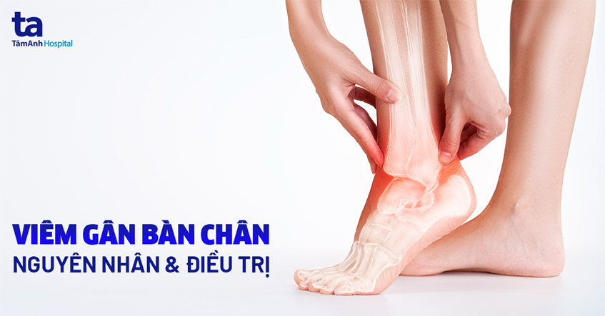 Gân Duỗi Bàn Chân: Nguyên Nhân, Triệu Chứng Và Cách Điều Trị Gallery 2