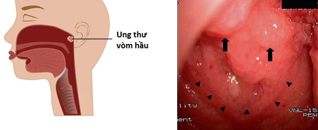 Viêm Vòm Mũi Họng: Nguyên Nhân, Triệu Chứng và Cách Điều Trị Gallery 2