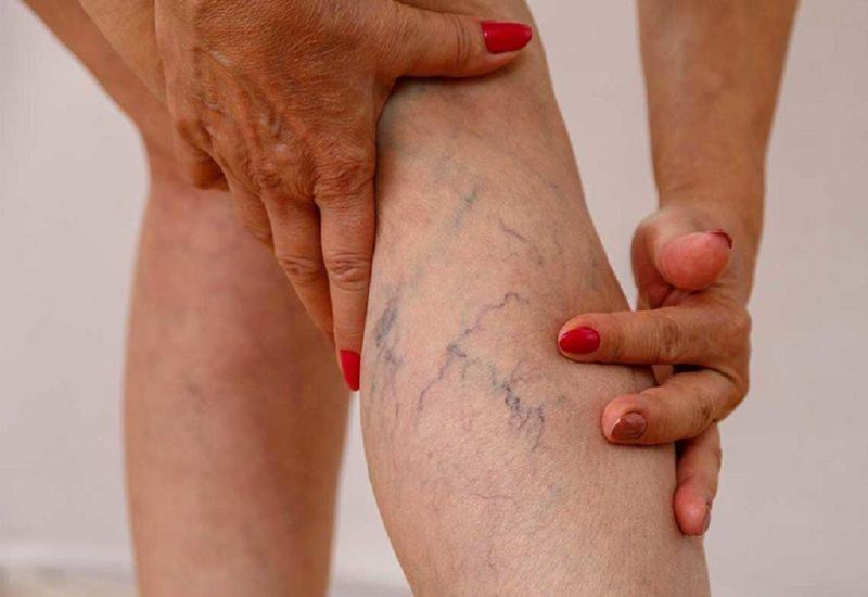 Vỡ Vein Là Gì? Gallery 2