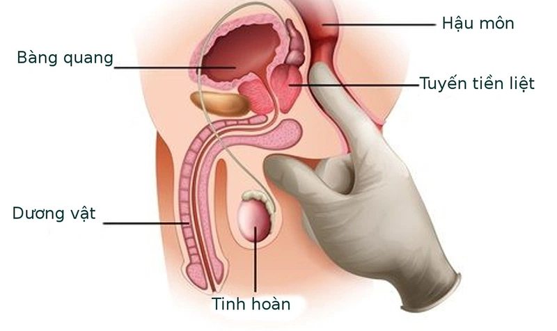 Vôi hóa tuyến tiền liệt là gì? Gallery 2
