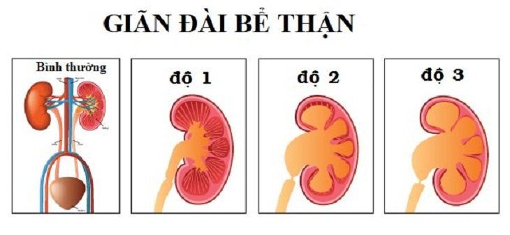 Giãn bể thận ở trẻ em Gallery 2