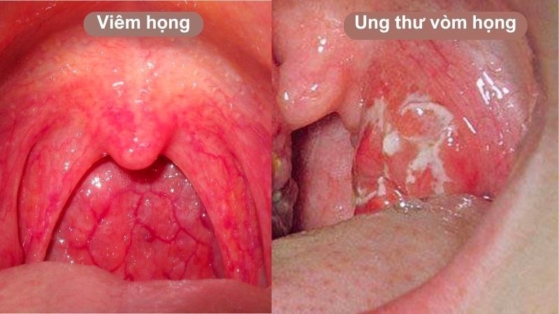 Triệu chứng ung thư vòm họng