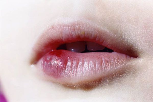 Muỗi Đốt Vào Môi: Nguyên Nhân, Triệu Chứng Và Cách Điều Trị Gallery 2