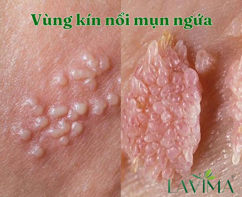 Nổi mẩn ngứa ở vùng kín: Nguyên nhân, triệu chứng và cách điều trị Gallery 2