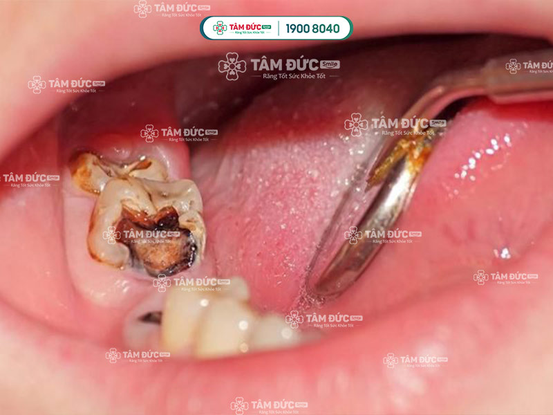 Răng cối bị sâu: Nguyên nhân, triệu chứng và cách điều trị Gallery 2