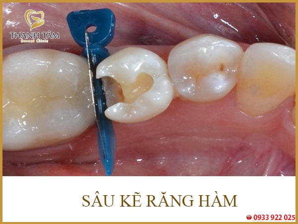 Sâu Kẽ Răng Hàm Gallery 2