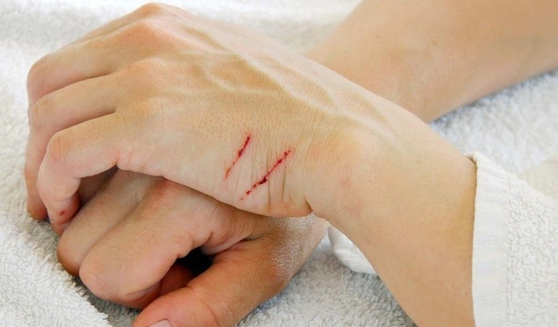 Triệu chứng sau khi bị chó cào: Cần làm gì khi bị chó cào?