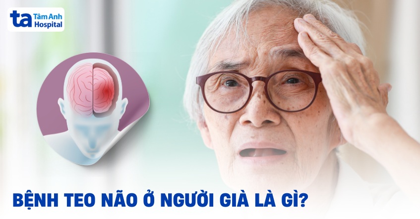 Teo Não Ở Người Già: Nguyên Nhân, Triệu Chứng Và Cách Phòng Ngừa Gallery 2