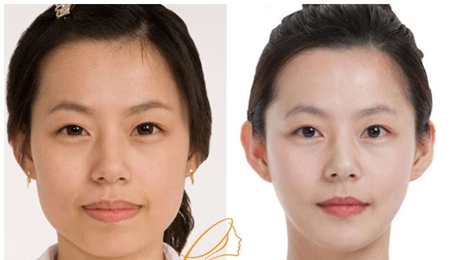 Thái Dương Bị Hóp: Nguyên Nhân, Triệu Chứng Và Cách Điều Trị Gallery 2