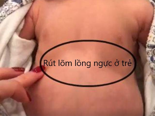 Thở Rút Lõm Ở Trẻ Gallery 2