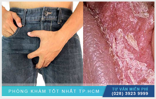Tróc da vùng kín nam: Nguyên nhân, triệu chứng và cách điều trị Gallery 2