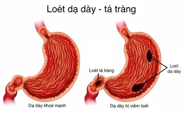 Viêm Loét Dạ Dày Tá Tràng Theo Bộ Y Tế Gallery 2