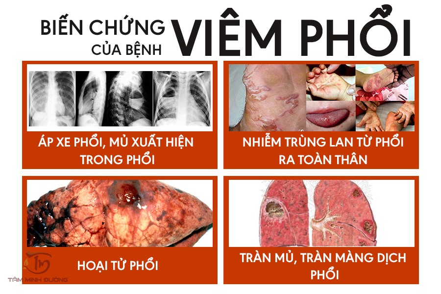 Bài giảng Viêm phổi Gallery 2