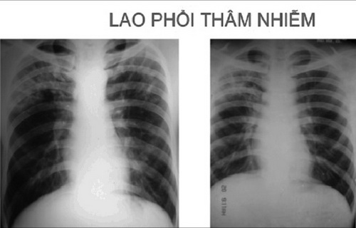 Viêm Phổi và Lao Phổi Khác Nhau Như Thế Nào? Gallery 2