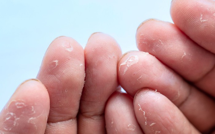 Tróc da đầu ngón tay: Nguyên nhân và cách điều trị