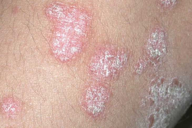 Tróc da vùng kín nam: Nguyên nhân, triệu chứng và cách điều trị